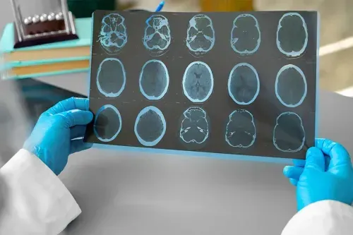 Acromegaly Causes and Symptoms, Complications, Treatments